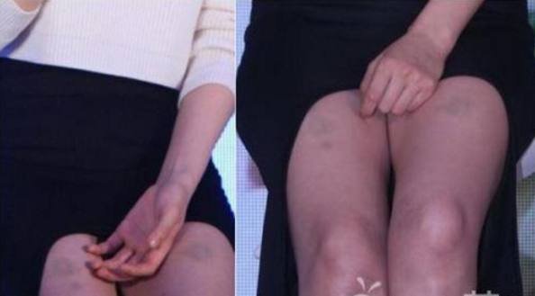 高圆圆深夜晒大腿淤青照,网友:又被家暴了吗