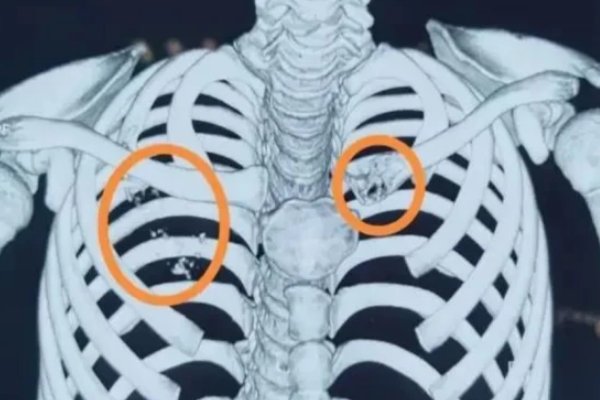 揪心！12岁小学生确诊肺癌晚期，这么年轻为何会患肺癌？