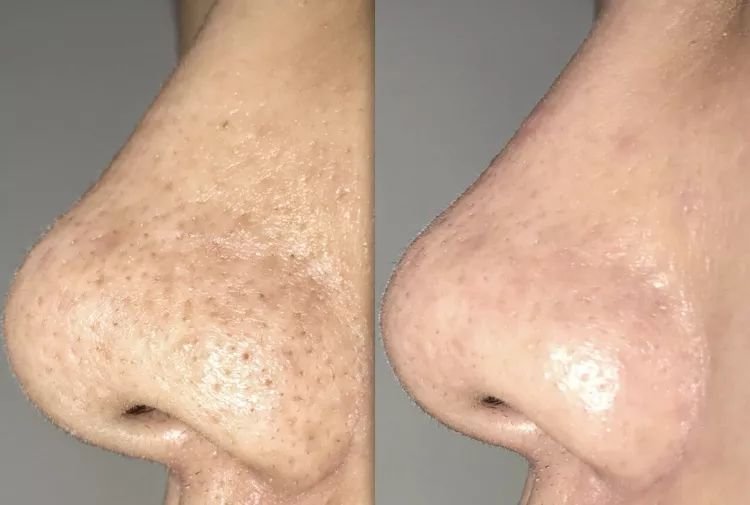 用什么方法去黑头效果最好?