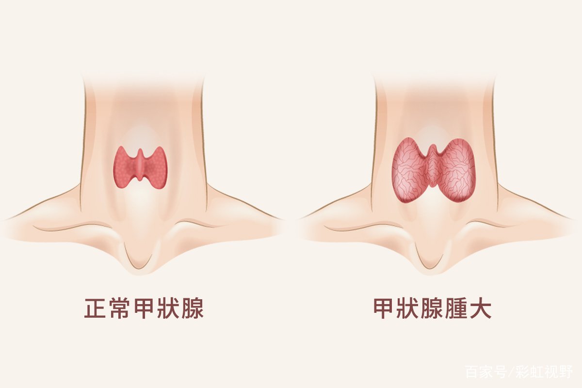 甲状腺肿大最常见的原因是什么？