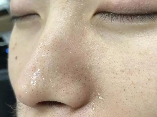 用什么方法去黑头效果最好?