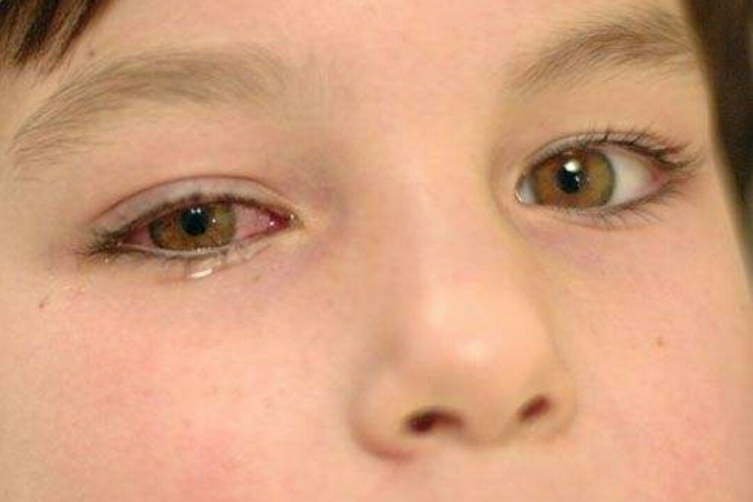 宁波小姑娘一做数学就眼睛过敏,你如何看待此事?