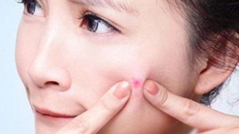 青春痘长什么样