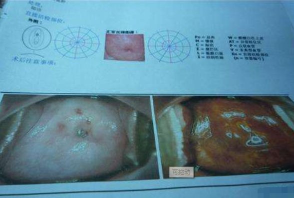 宫颈纳氏囊肿是什么意思啊....