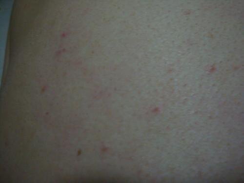 背上的痘痘怎么消去？