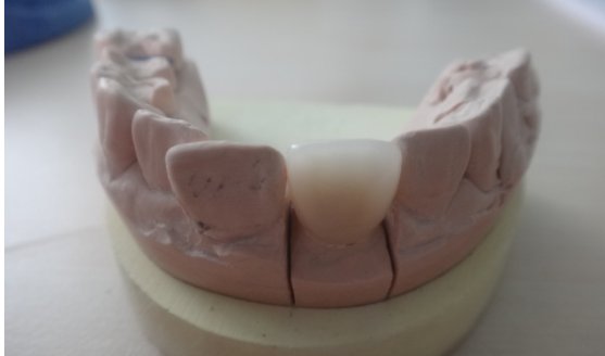 二氧化锆烤瓷牙正常一颗多少钱呢