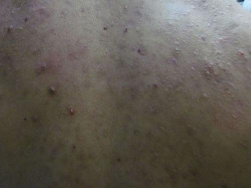 背上的痘痘怎么消去？