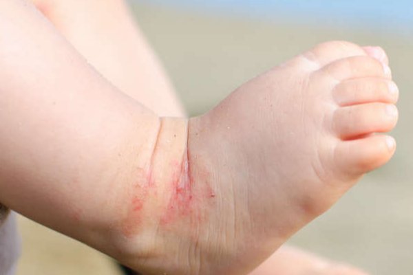 湿疹是什么原因引起的？