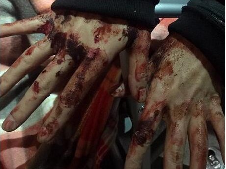 杨幂受伤是怎么回事?