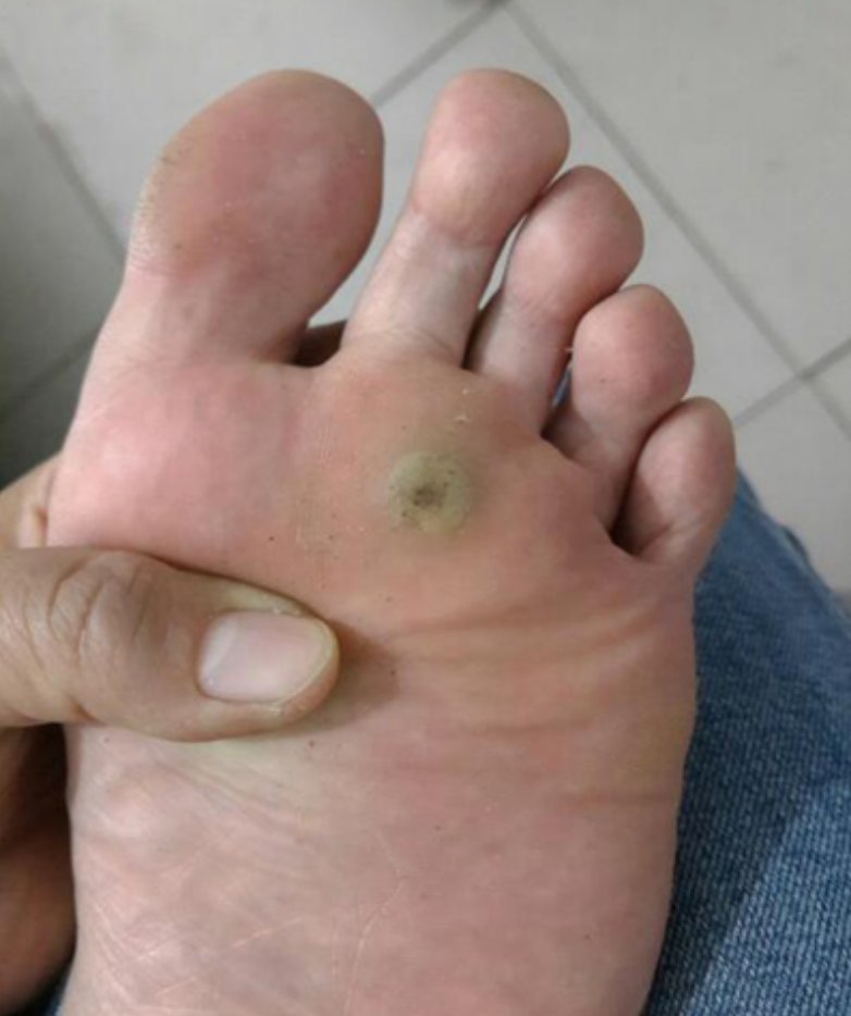 跖疣图片是什么样子的?