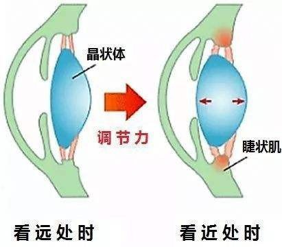 真性近视能治好吗