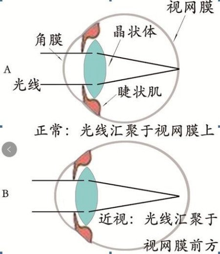 真性近视能治好吗