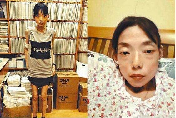 名模伍智恒八年内切割肠胃,全身瘫痪如怪物,如今又怎样了?