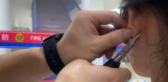 天太热塑料塞子晒化了，杭州一女子耳朵被耳钉黏住，最终是如何将其取下的？