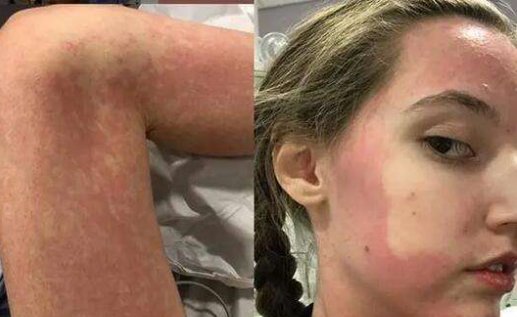 对所有食物过敏英国女子，她是靠什么为生的？