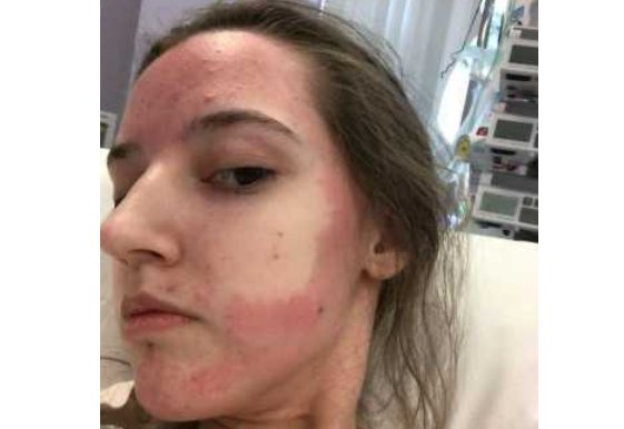 对所有食物过敏英国女子，她是靠什么为生的？